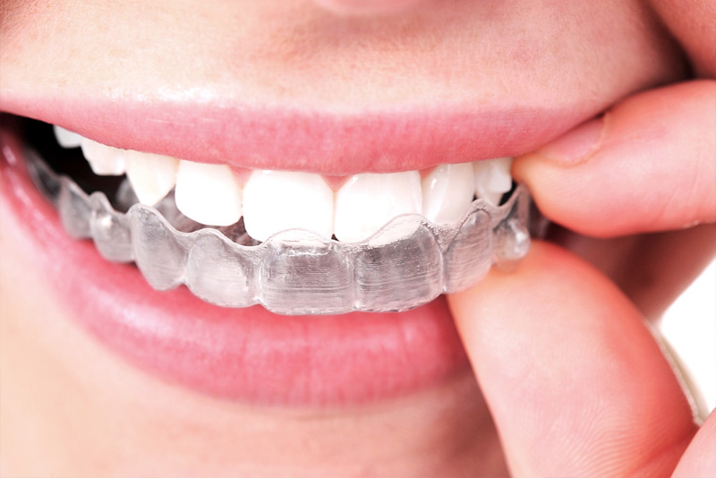 Treatment Transparent Braces - Hagens